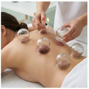 Cupping Therapy